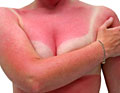 woman badly sunburned